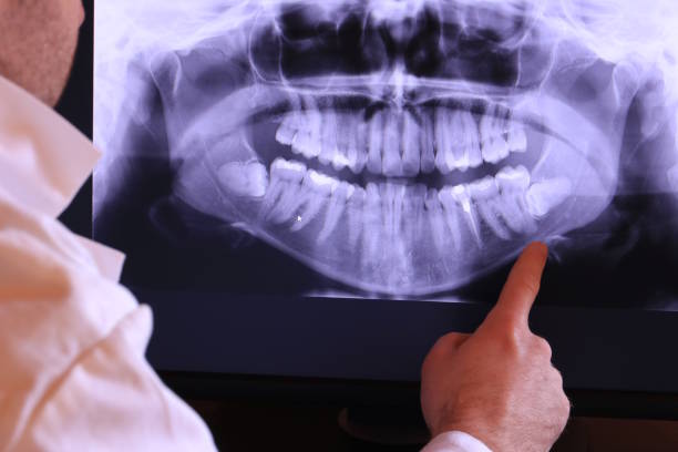 Best Emergency Tooth Extraction in Bidwell, OH