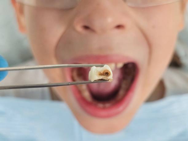 Best Emergency Treatment for Dental Infections or Abscesses in Bidwell, OH