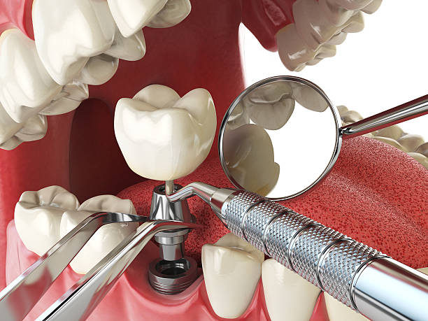 Best Urgent Care for Lost Fillings or Crowns in Bidwell, OH